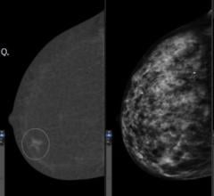 研究旨在确定杰姆提高致密乳房的女性乳腺癌的检测
