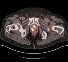 18f - rhpma -7.3 PET图像显示一名新诊断为前列腺癌的男性前列腺多区域摄取。图片由Blue Earth Diagnostics提供