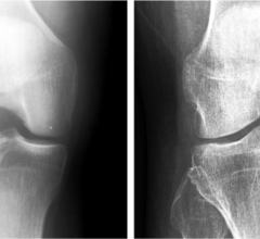 AI试图检测膝关节胫骨结节上是否有spike。胫骨尖刺可能是骨关节炎的征兆。图片:Jyväskylä大学。图片由Jyväskylä大学提供