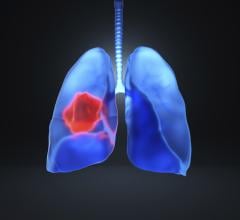 该行业看到了行业领导者帮助扩大肺部筛查项目的势头